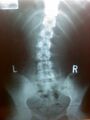 Hay guize, check out my curvature of the spine! This is the lower back!11
