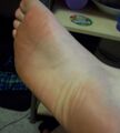 Freckle on foot...